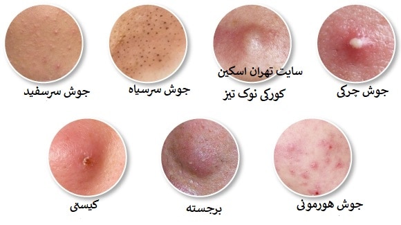 درمان انواع آکنه جوش در مرکز برکه