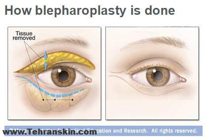 eyelid surgery