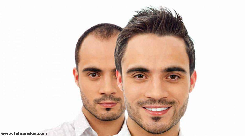 پیوند موها چگونه انجام می شود؟ | روش های کاشت مو | مراقبت ها و عوارض