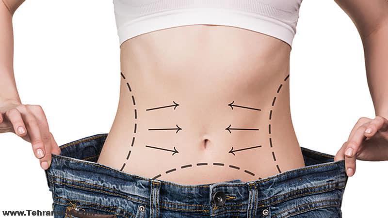 هزینه پیکرتراشی شکم