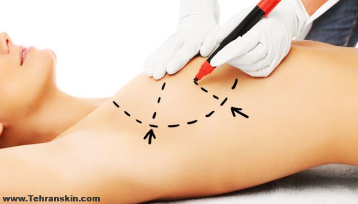 Breasts Surgery in iran