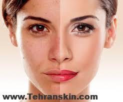 درمان هایپرپیگمنتیشن