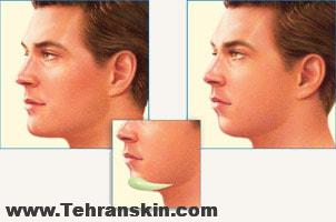 Chin augmentation in Iran