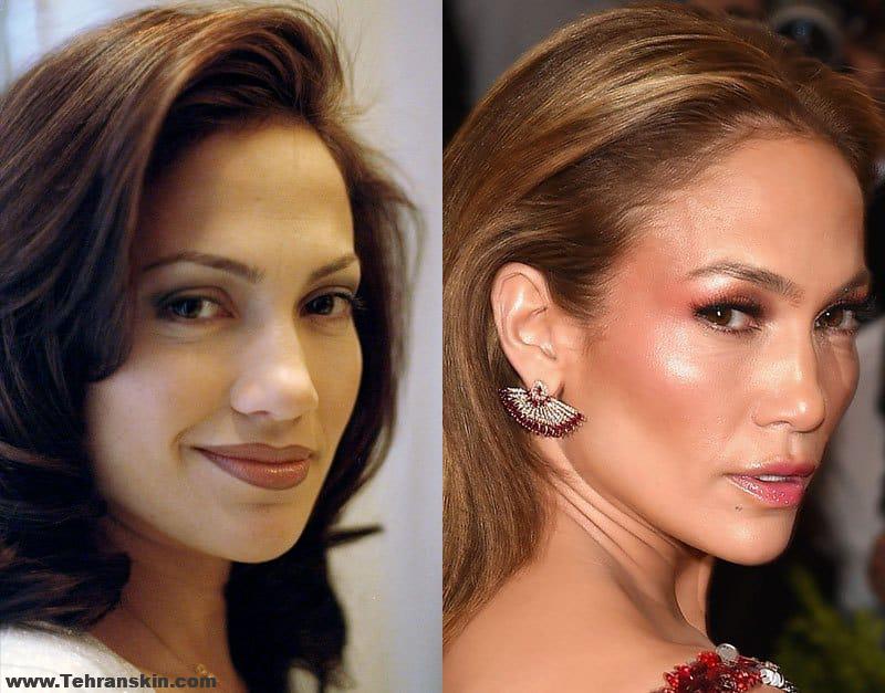 با رینوپلاستی مشکلات تنفسی خود را از بین ببرید | خطر مرگ به علت جراحی زیبایی بینی