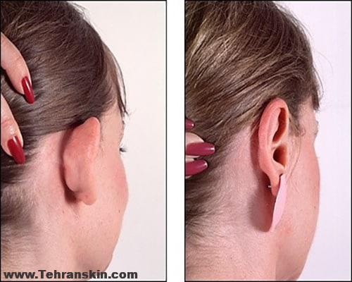 ناهنجاری های گوش | مزایای جراحی زیبایی گوش | بهترین متخصص جراحی زیبایی گوش