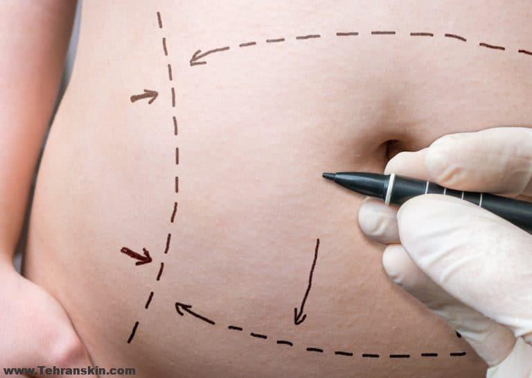 abdominoplasty in iran