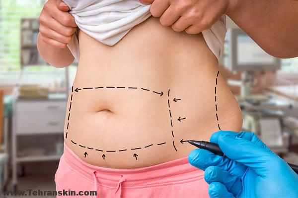برداشتن چربی