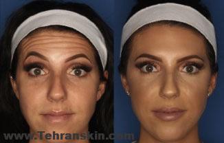 تزریق بوتاکس در اطراف چشم ها