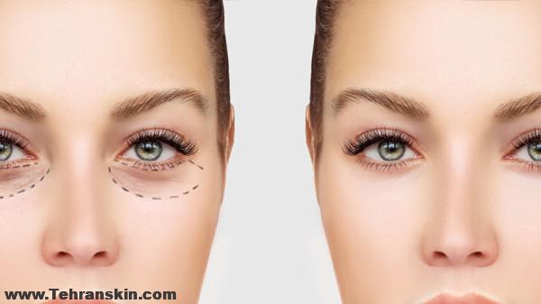 عمل بلفاروپلاستی چیست؟