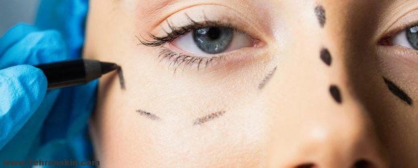 دکتر خوب بلفاروپلاستی