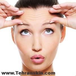 بلفاروپلاستی برای افتادگی پلک