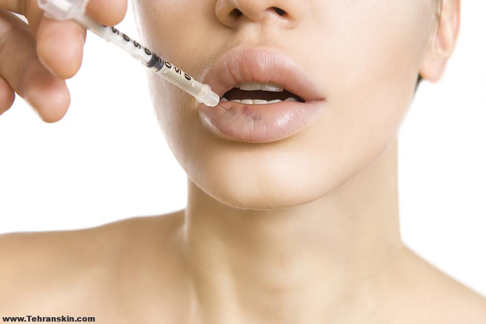 تزریق ژل لب در ساری