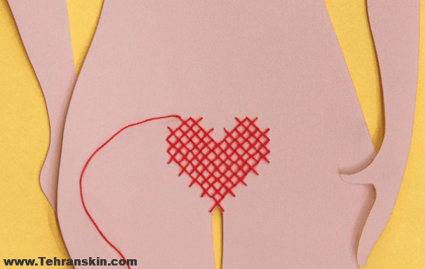 عوارض لیزر بیکینی و زیر بغل