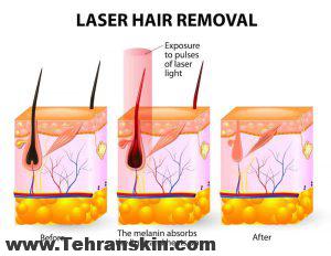 چگونه با لیزر موهای زائد از بین میرود