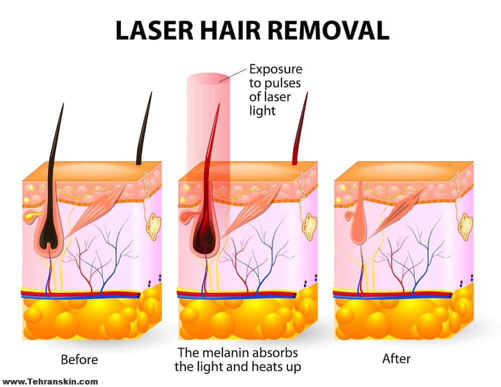 چگونه با لیزر موهای زائد از بین میرود