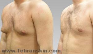 التثدي هو حالة من الثديين المتضخمة أو المتضخمة في الرجال التي يمكن أن تحدث في أي عمر