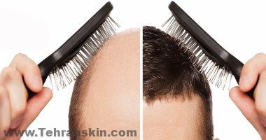عندما يتقدم تساقط الشعر بعد الجراحة ، قد تظهر نتيجة غير طبيعيةغير مكتملة"