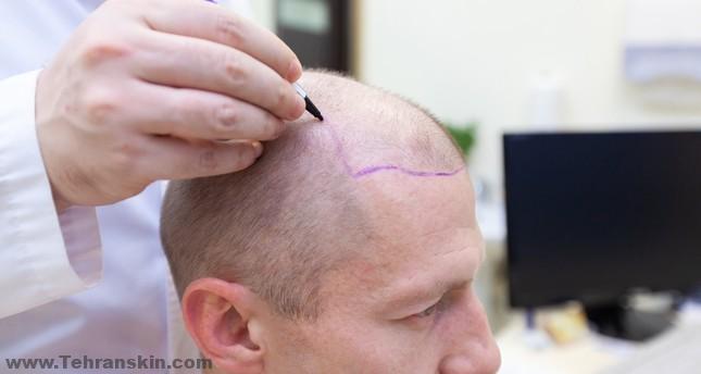 تتضمن زراعة الشعر إزالة أجزاء صغيرة من فروة الرأس الحاملة من موقع متبرع