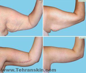 رفع الذراع قبل وبعد الصور