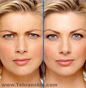 عندما تبدأ آثار توكسين البوتولينوم في التلاشي ، ستعود ردود فعل العضلات والتجاعيد.