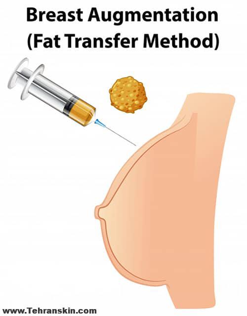 fat transfer to breast