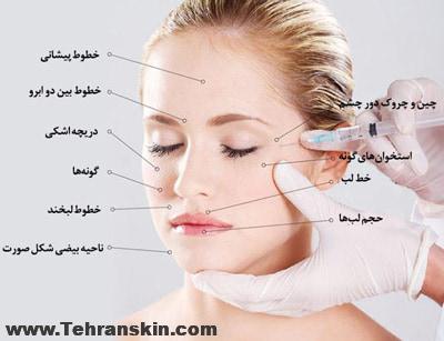 تزریق فیلر های پوستی در نواحی مختلف صورت
