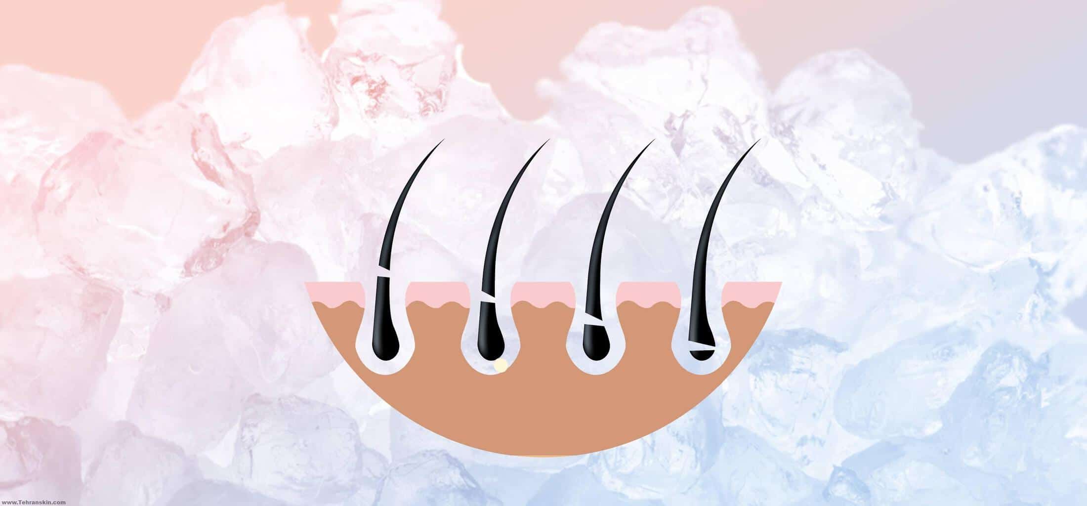 لیزر بیکینی درد داره؟ لیزر بیکینی خوبه؟ لیزر بیکینی همراه با واقعیت مجازی در مرکز برکه hair glamour 21aug18 sf - لیزر بیکینی درد داره؟ لیزر بیکینی خوبه؟ لیزر بیکینی همراه با واقعیت مجازی در مرکز برکه