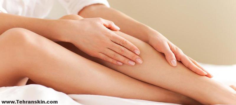 لیزر موهای پا زنان