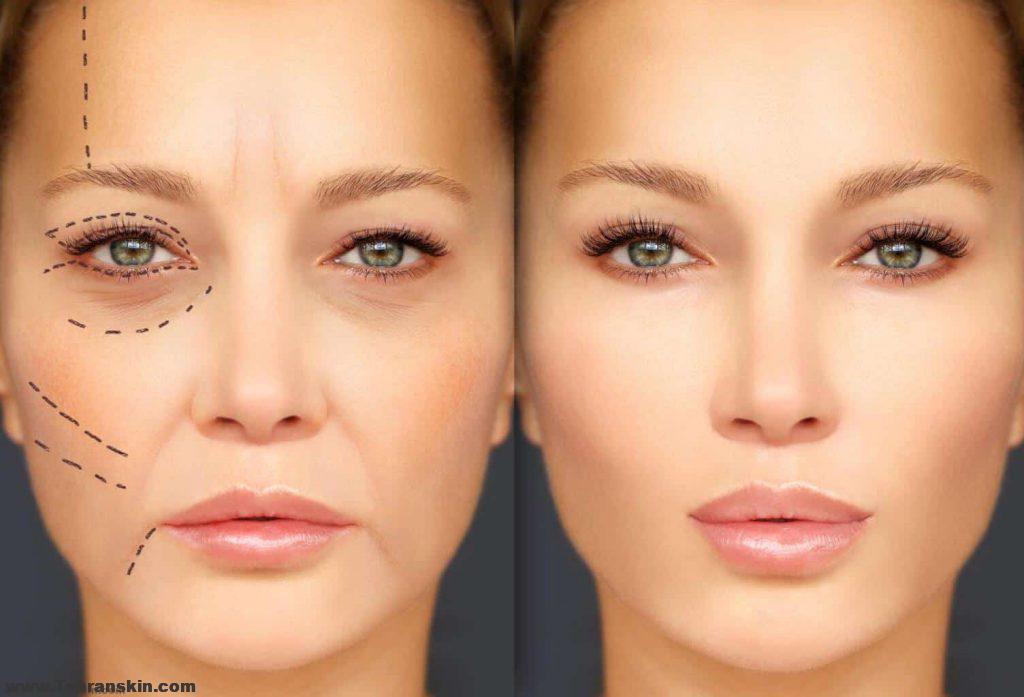 عندما تبدأ آثار توكسين البوتولينوم في التلاشي ، ستعود ردود فعل العضلات والتجاعيد.