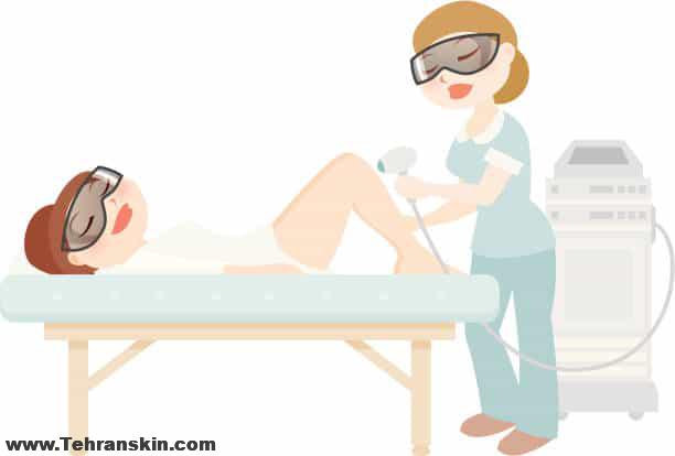 لیزر موهای زائد