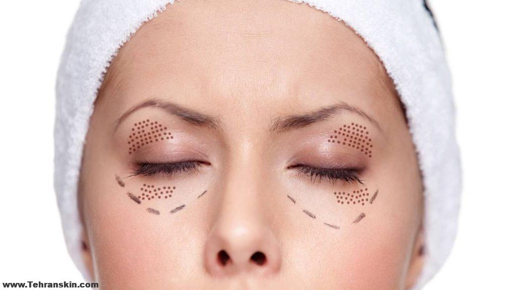 light medical eyelift