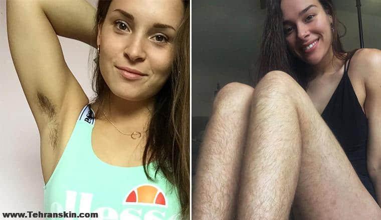 لیزر موهای زائد