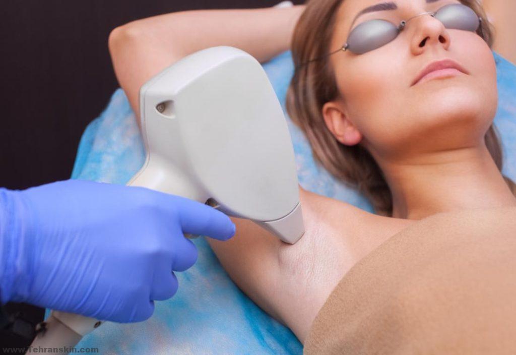woman having laser hair removal on her armpit 2 1024x704 - آیا شایعه ی تاثیر لیزر موهای زائد بر باروری واقعیت دارد یا نه؟ | لیزر در دوران بارداری
