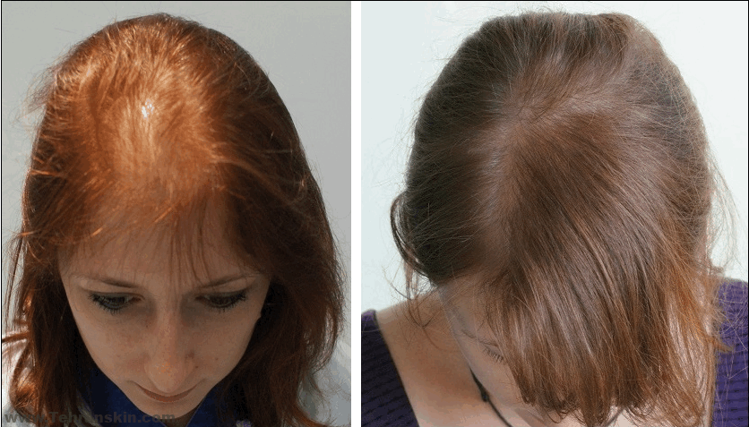 ما هي إجراءات زراعة الشعر الموصى بها للنساء؟