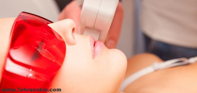 نصائح ذهبية قبل إزالة الشعر بالليزر