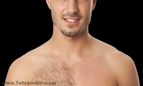 لیزر مو برای مردان