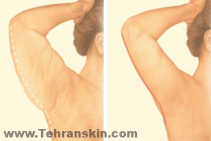 يتم وضع الشقوق بشكل عام في الجزء الداخلي من الذراع أو على الجزء الخلفي من الذراع ، وهذا يتوقف على تفضيل الجراح 