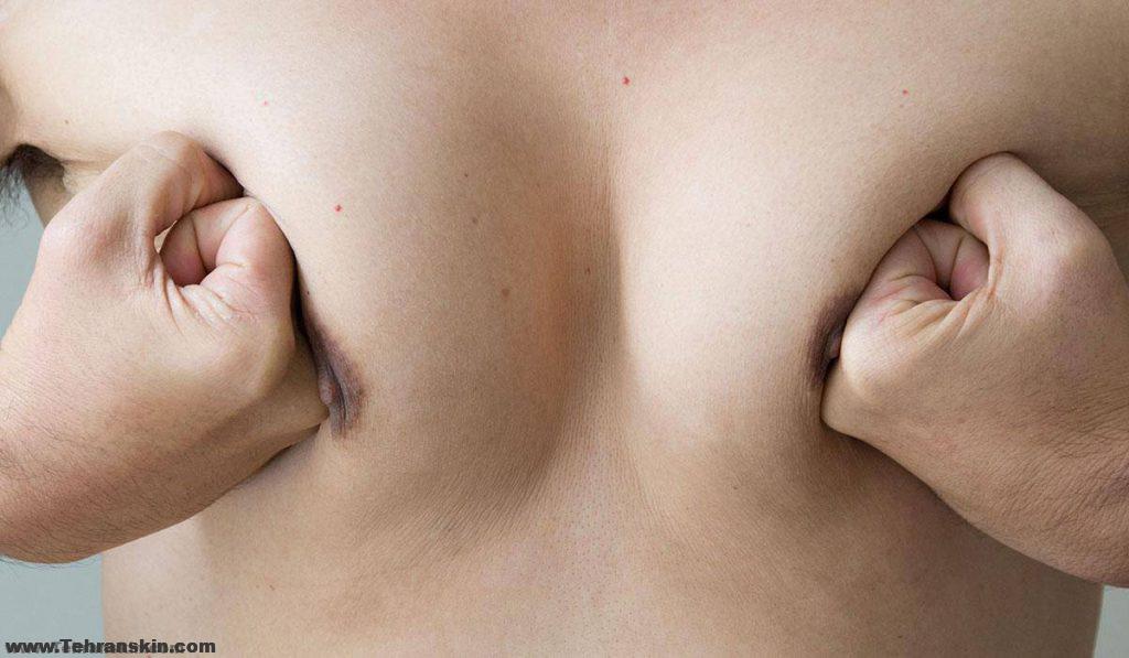 التثدي يمكن أن يسبب عدم الراحة العاطفية ويضعف ثقتك بنفسك