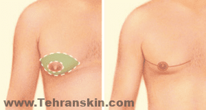 يوصى باستخدام تقنيات الختان حيث يجب إزالة أنسجة الثدي الغدية أو الجلد الزائد لتصحيح التثدي