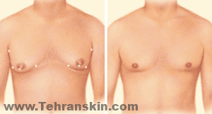 في الحالات التي يكون فيها التثدي ناتجًا بشكل أساسي عن الأنسجة الدهنية الزائدة ، يمكن استخدام تقنيات شفط الدهون وحدها