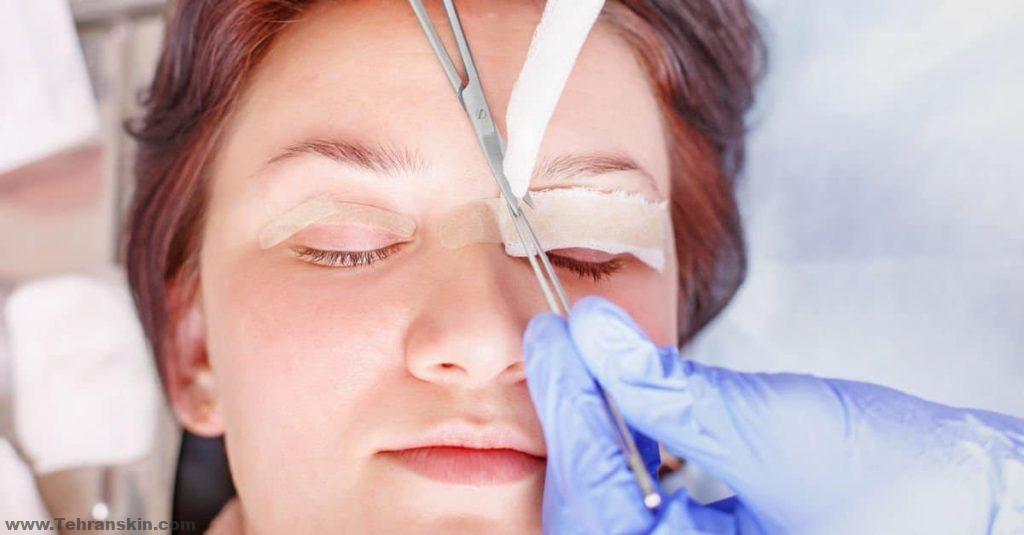 ، قد يتم تطبيق مرهم التشحيم والكمادات الباردة ، وفي بعض الحالات قد تكون عينيك مغطاة بشاش ، بعد اكتمال الإجراء.