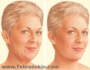 يستخدم بديل شد الوجه التقليدي شقوقًا أقصر في المعابد