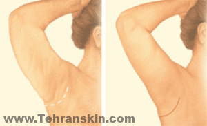 يتم وضع الشقوق بشكل عام في الجزء الداخلي من الذراع أو على الجزء الخلفي من الذراع ، وهذا يتوقف على تفضيل الجراح 