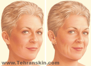 يعالج ربطة العنق الأطواق المتدلية والجلد الفضفاض وتراكم الدهون تحت الذقن