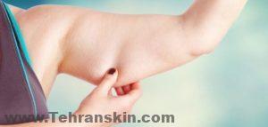 شد الذراع ، أو رأب العضلة ، هو إجراء جراحي: