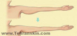 الأسئلة التي يجب أن أسألها جراح التجميل عن عملية شد الذراع