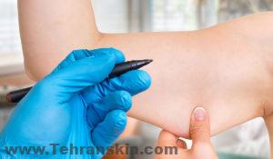 ما هي خطوات عملية شد الذراع؟