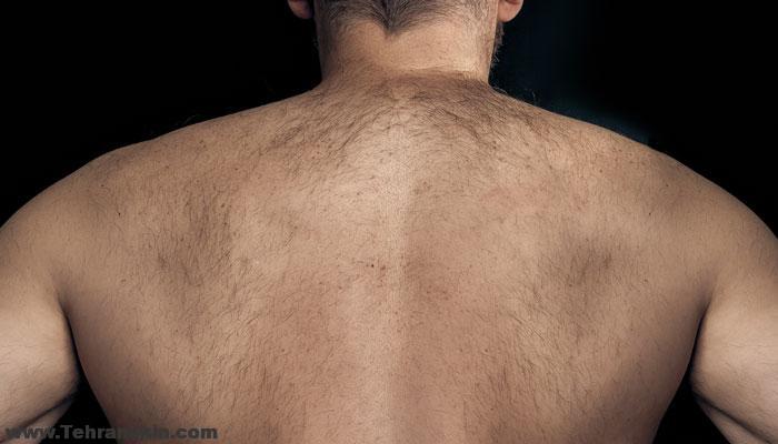 لیزر مو برای مردان