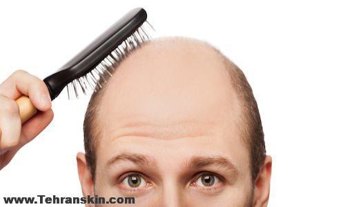 کاشت مو در اردبیل