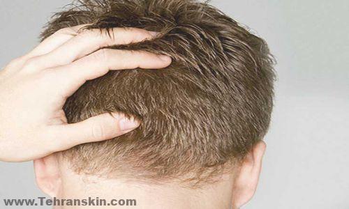 آیا کاشت مو تاثیر دارد ؟